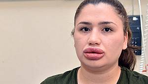 Türkiye'yi sarsan şiş dudak davası 