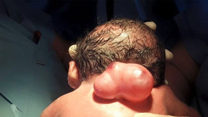 Omuriliği Dışarıda Doğan Bebek, Doğumundan 8 Saat Sonra Ameliyat Edildi